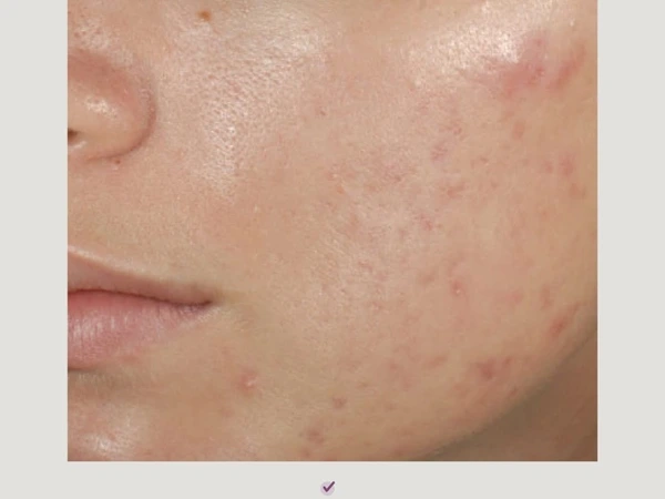 Clear Improvement Facial