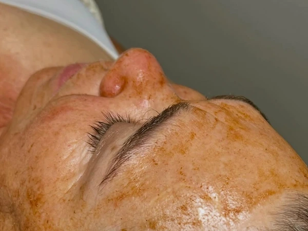 Chemical Peel Facial