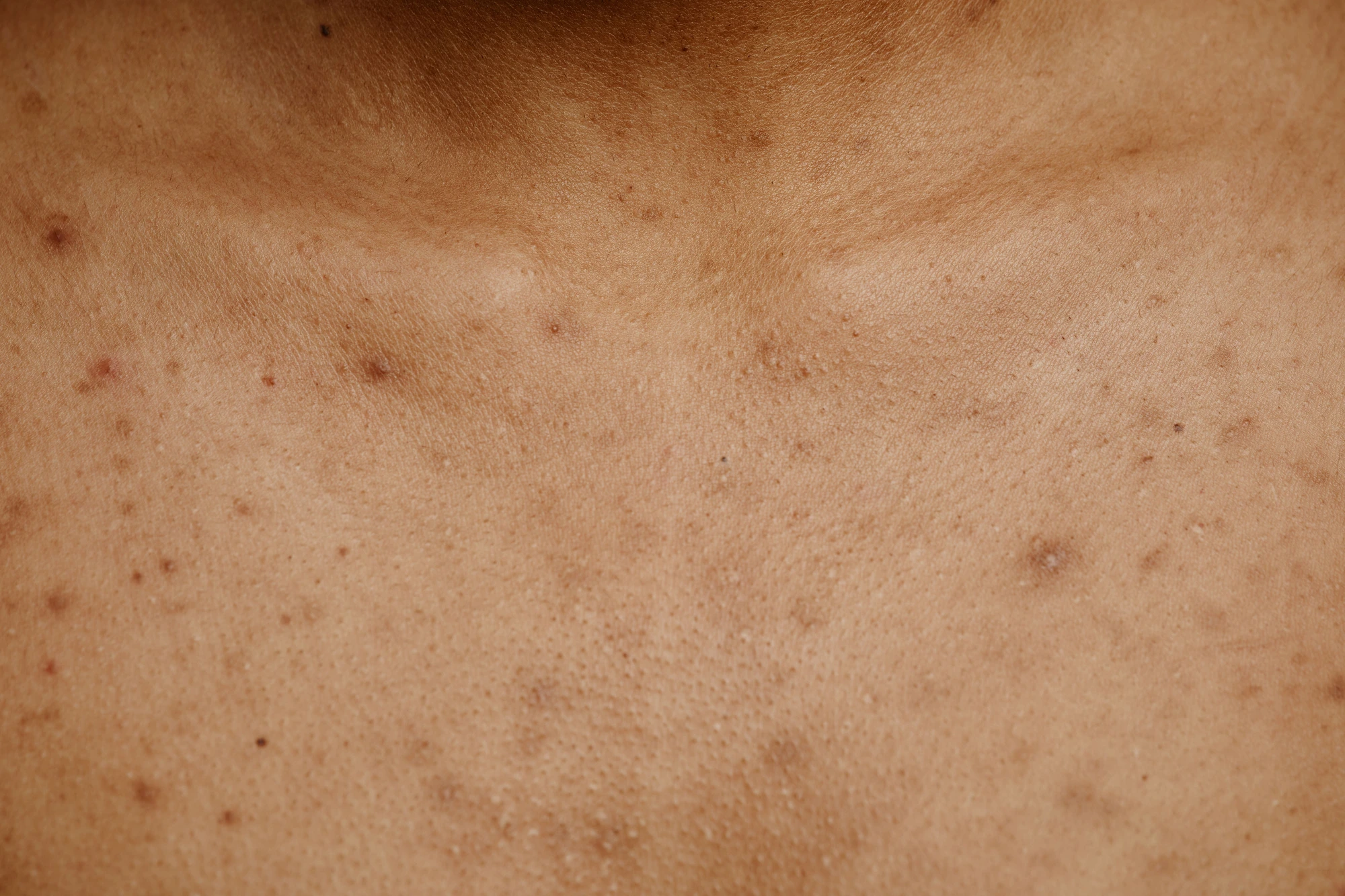 Why Fall Is the Best Time for Corrective Facials and Hyperpigmentation Treatment