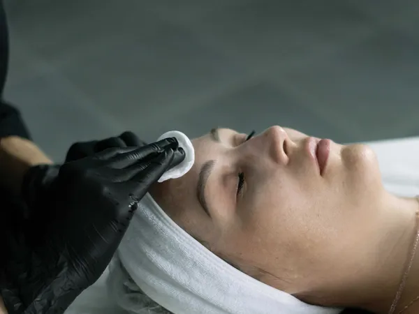 Chemical Peel