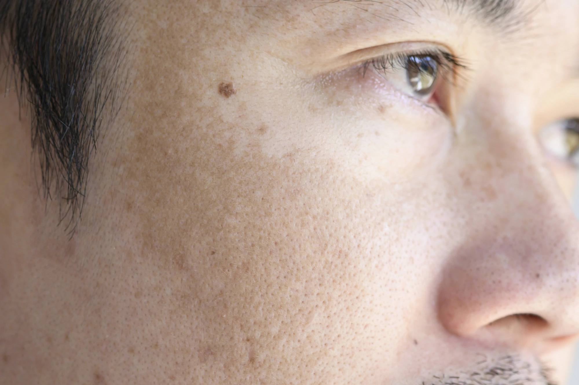 Melasma Relief That Lasts: A Whole-Person Approach in Denver Metro Area