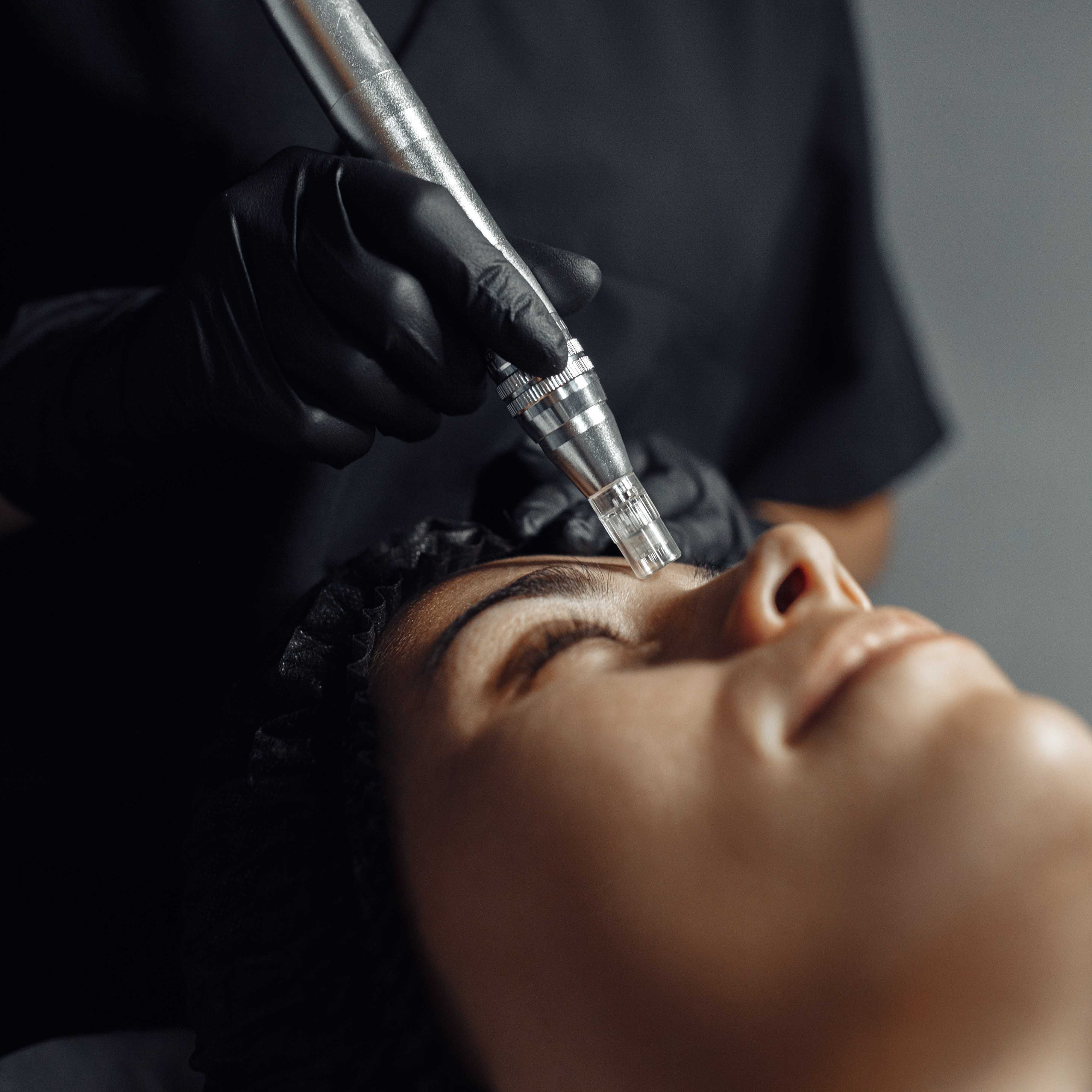 Microneedling